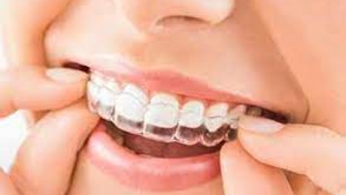 İnvisalign Tedavi Nedir? Tedavi Süresi Ne Kadar?